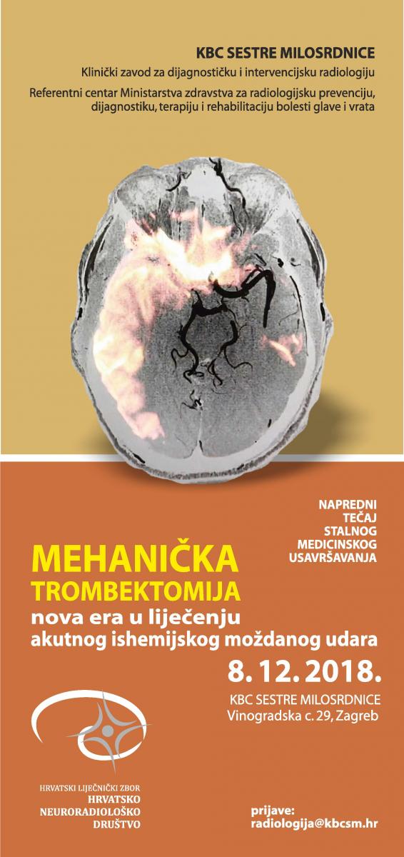 Mehanička trombektomija -  nova era u liječenju akutnog ishemijskog moždanog udara
